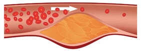 Illustration of a blood vessel with plaque.