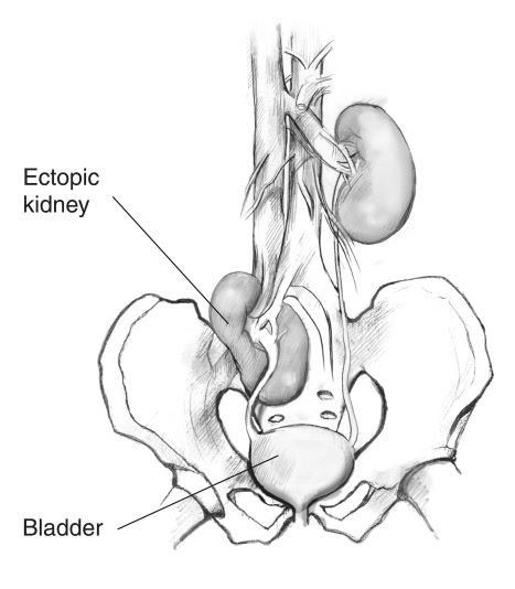 An ectopic kidney and surrounding internal structures.