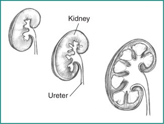 Cross section of the kidney in three stages of normal development. Labels point to the kidney and ureter.