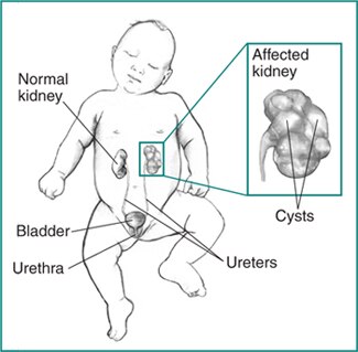 Urinary tract in an infant, with labels pointing to a normal kidney, ureters, bladder, and urethra. Inset shows an affected kidney with cysts.