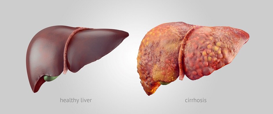 A healthy liver and a liver with cirrhosis.