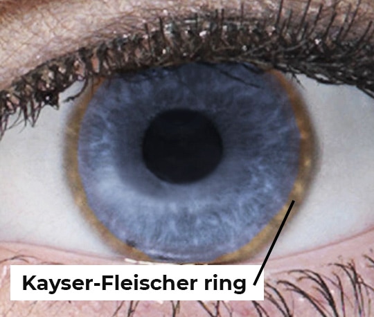 Close-up photo of an eye with a Kayser-Fleischer ring.