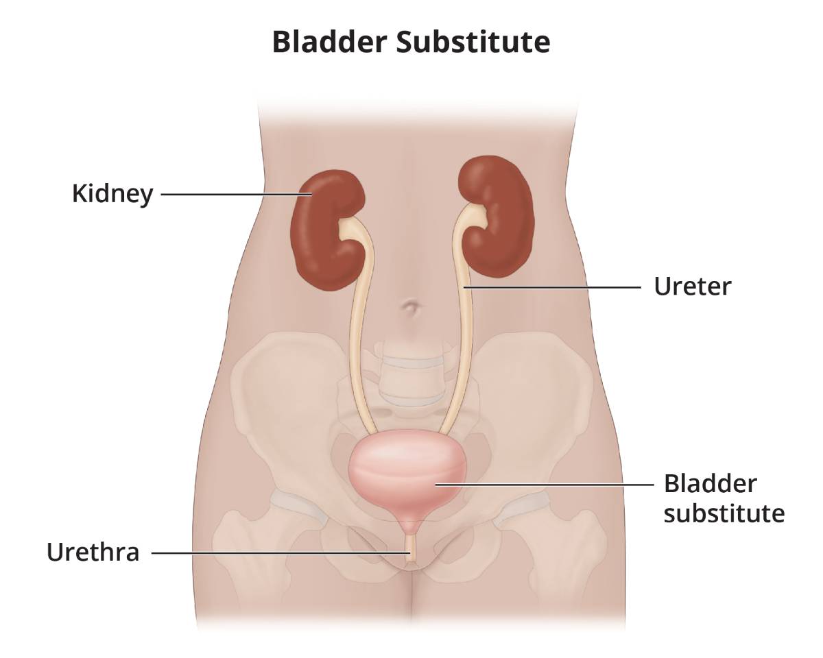 Ureters attach to a bladder substitute and the bladder substitute empties through the urethra.