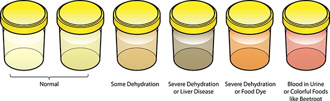 A series of urine samples. Light-colored urine is normal. Deep-yellow urine suggests dehydration. Dark brown or orange urine suggests severe dehydration or liver disease. Urine that is pink suggests blood in the urine or having eaten beets. Odd urine color may also be caused by eating foods with large amounts of dyes.