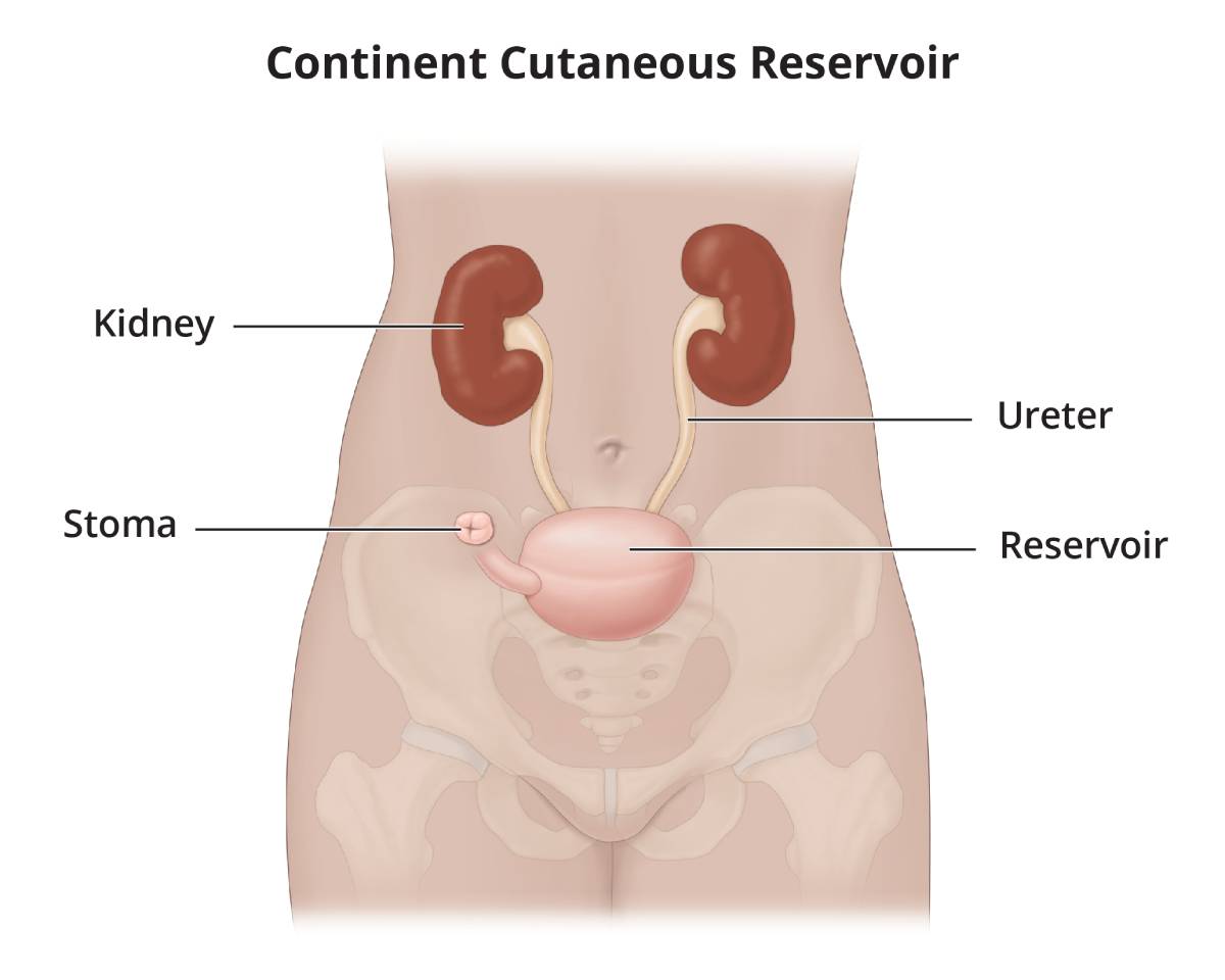 A continent cutaneous reservoir attaches the ureters to an internal pouch, which empties through a stoma.