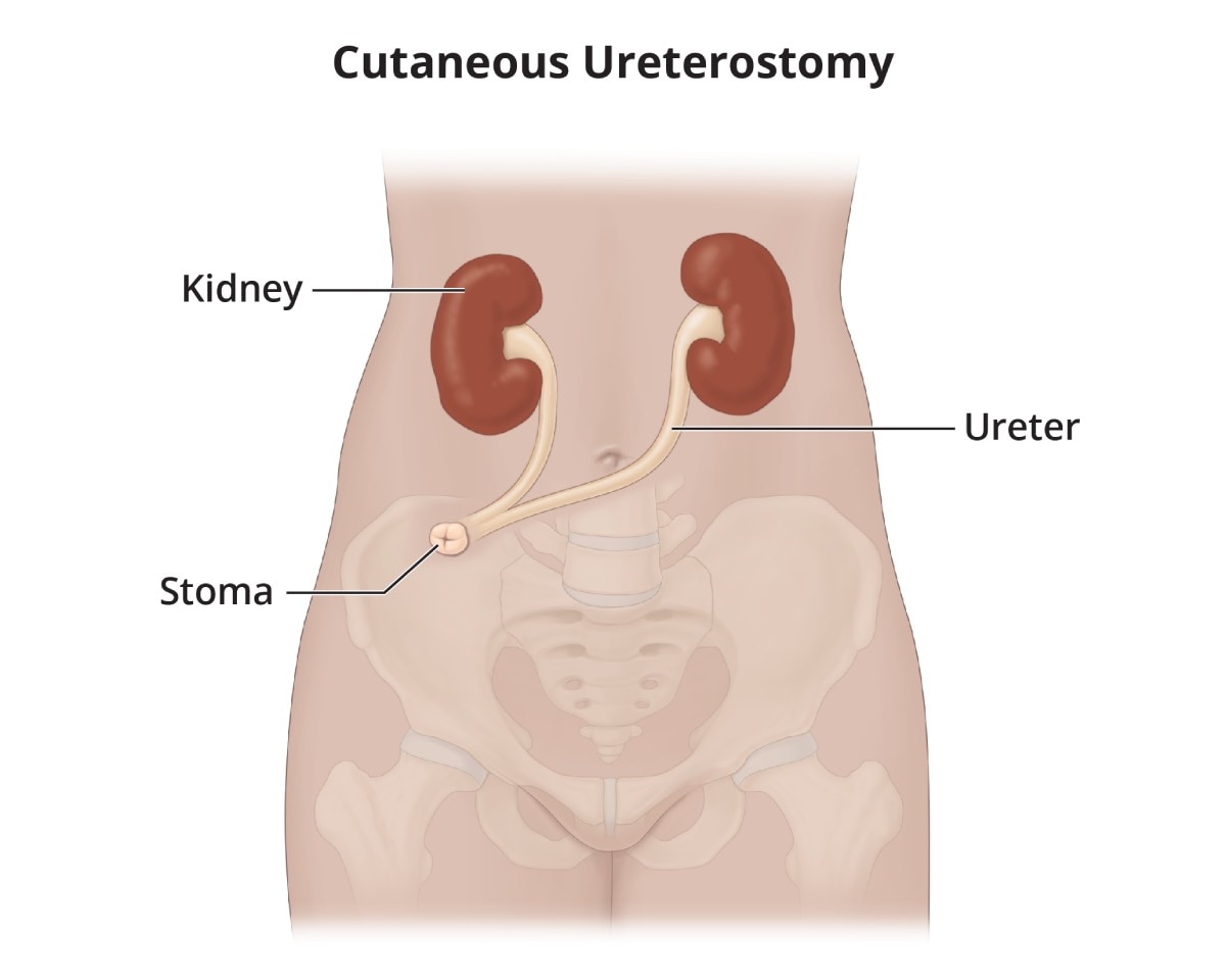 A cutaneous ureterostomy with both ureters attached to a stoma.