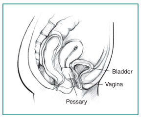 A pessary inserted into the vagina to support the bladder.