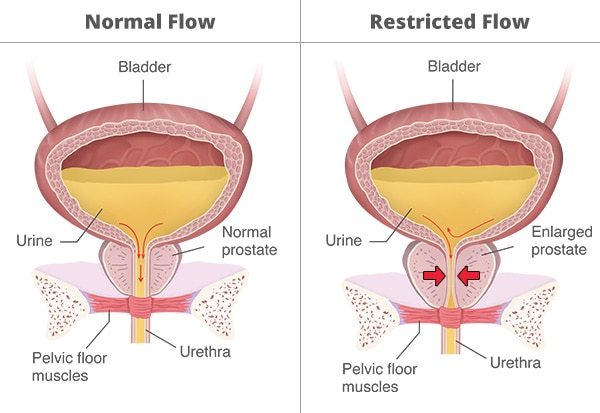 Two bladders showing normal versus restricted urine flow as caused by an enlarged prostate and urethra constriction.