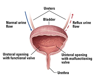 An illustration of a bladder, including the urethra and two ureters. One ureter allows urine to flow normally into the bladder; the other is damaged and refluxes, sending urine back toward the kidney.
