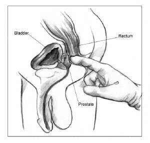 Diagram of male genitalia, rectum with doctor’s finger insertion.
