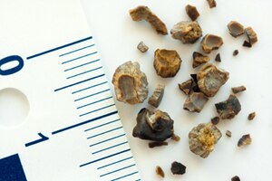 Kidney stones of varying sizes and shapes.