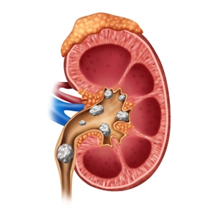 Illustration of a human kidney with several kidney stones blocking the urinary tract.