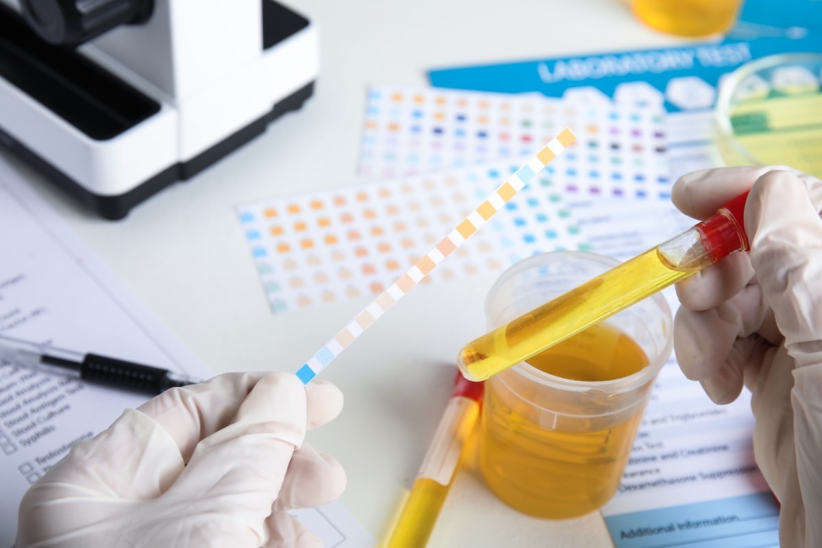 A laboratory technician holds a tube containing urine up against a urine test strip.