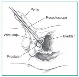 Cross-section of the penis, prostate, and bladder.  A resectoscope is inserted through the urethra to the prostate.  A wire loop at the end of the resectoscope cuts tissue from the prostate.