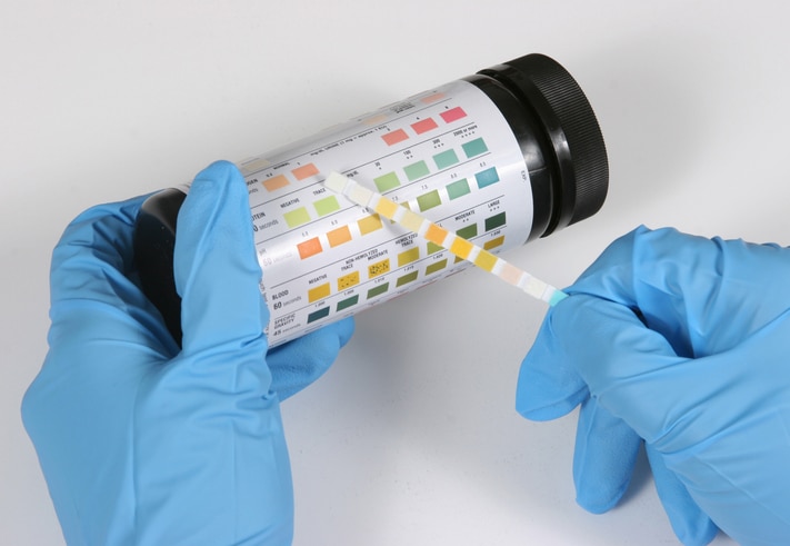 A lab tech compares a urinalysis test strip against a results chart.