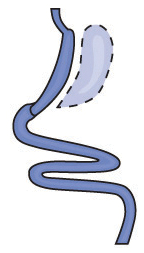Procedimiento de manga gástrica que muestra una sección larga de intestino con una porción de estómago extirpada