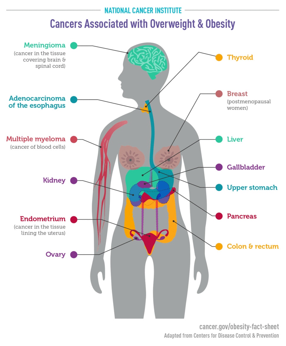 Illustration of a human torso, with labels showing the different types of cancer associated with overweight and obesity. These cancers are: thyroid, breast (postmenopausal women), liver, gallbladder, upper stomach, pancreas, colon and rectum, ovary, endometrium (cancer in the tissue lining the uterus), kidney, multiple myeloma (cancer of blood cells), adenocarcinoma of the esophagus, and meningioma (cancer in the tissue covering the brain and spinal cord).