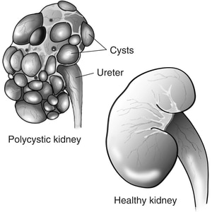 A smooth, healthy kidney and a polycystic kidney with many fluid-filled cysts on the surface.