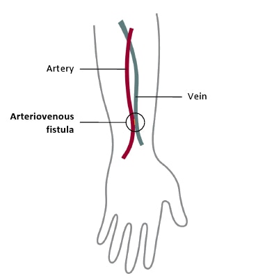 A schematic of an arteriovenous or AV fistula