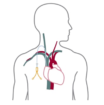 A schematic of a catheter for temporary access