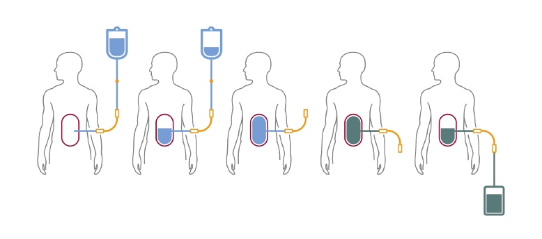 A schematic showing during a cycle of peritoneal dialysis or exchange