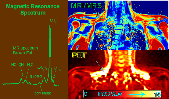 Magnetic resonance spectroscopy of brown adipose tissue.