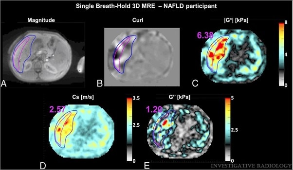 Single breath-hold 3D MRE (Intenso) for a patient with advanced fibrosis and intermediate inflammation.