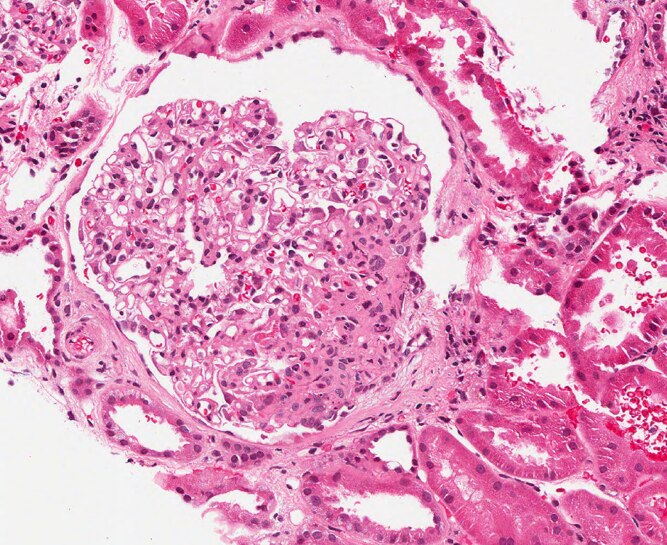 Kidney biopsy showing focal and segmental scarring of glomerulus typical of FSGS.