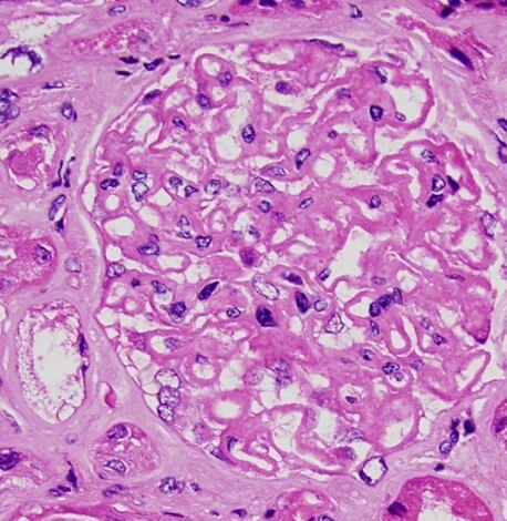 Kidney biopsy showing thickening of capillary loops in the glomerulus typical of membranous nephropathy.