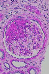 Photo of focal segmental glomerulosclerosis